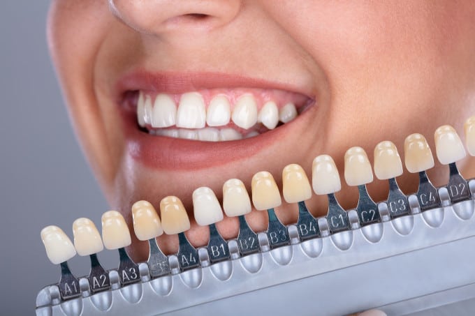 veneer whitening model with color choices