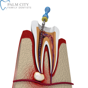 Emergency Root Canal Dentist Near Me in Palm City, FL